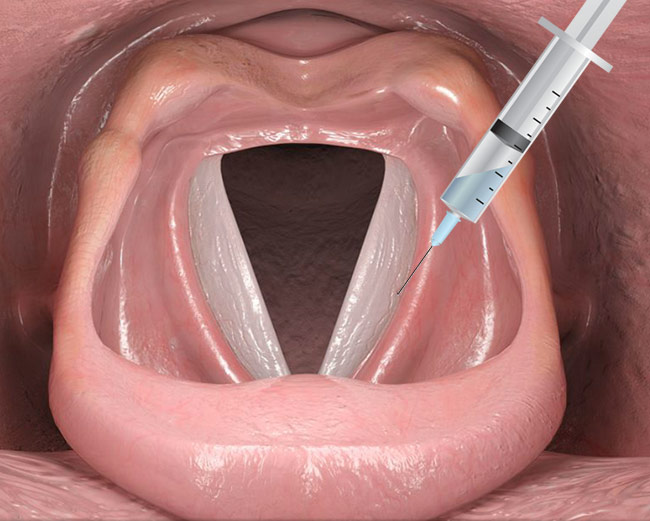 vocal cord injections